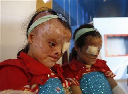 伊拉克贫铀弹儿童图片